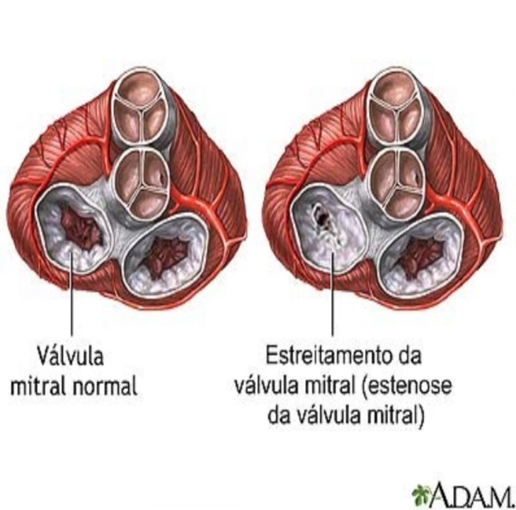 Estenose Mitral CardioInterv MaterDei