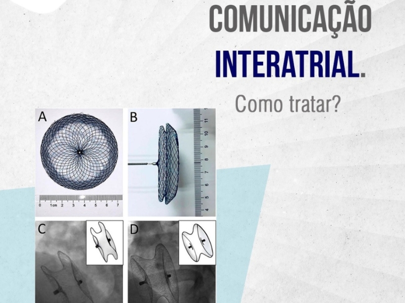 Comunicação Interatrial. Como tratar?