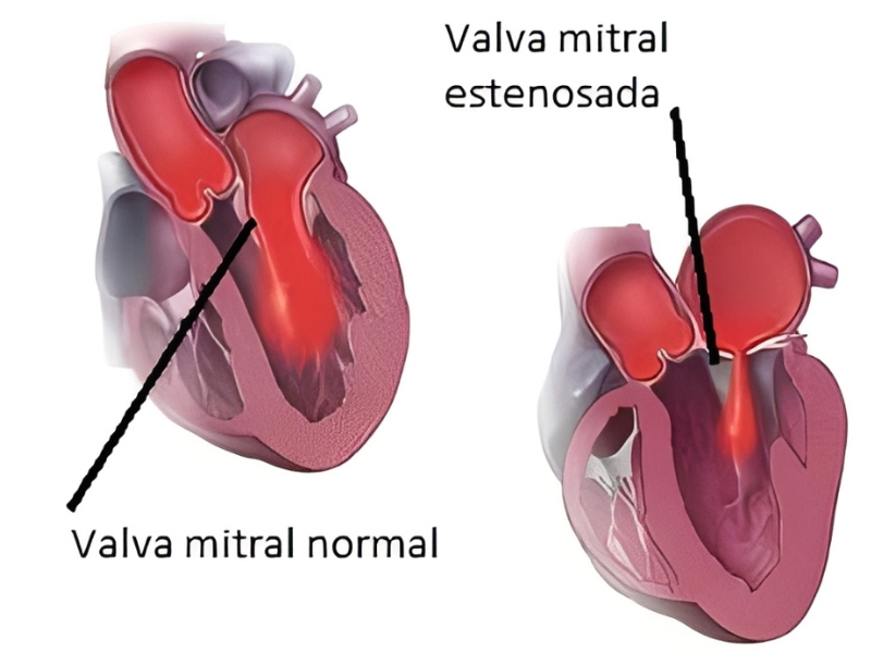 Estenose Mitral