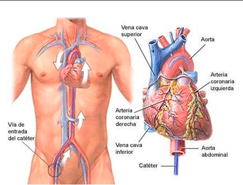 Coronariografia: Orientações pós-procedimento
